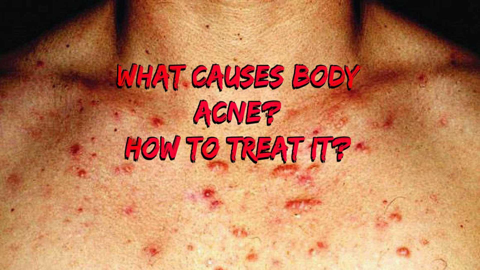 What Causes Body Acne and How to Treat It? image